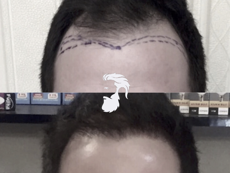Photos avant-après l'intervention d'un greffe de cheveux par FUE